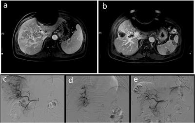 Prospective study of TACE combined with sorafenib vs TACE combined with 125I seed implantation in the treatment of hepatocellular carcinoma with portal vein tumor thrombus and arterioportal fistulas